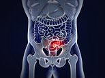 The deadly rectal cancer warning signs no one should ignore: Bleeding, bloating, lethargy and pencil-thin stools