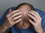 Health chiefs issue urgent safety warning over common hair loss pills that can trigger depression, suicidal thoughts and ‘sexual dysfunction’