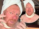 Leigh Francis suffers a nasty facial injury after interaction with overexcited fan as he shows off bloodied cut