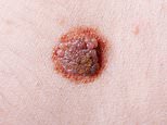 Skin cancer ‘set to surge by 2050’ with cases of deadly melanoma and other forms rising worldwide, major study warns