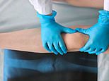 Calcium and Vitamin D supplements taken by millions DON’T prevent painful bone fractures and falls, study finds – BMJ