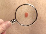 DR MAX PEMBERTON: I almost missed my own skin cancer – here’s EXACTLY what you need to look out for (and no, it’s not just moles or crusty skin patches)