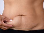 How to get rid of your saggy skin for good: So many suffer from loose or stretchy skin after losing weight… now our leading expert reveals the non-surgical remedies that work and those that are a waste of money