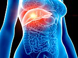 The foods and drinks that are linked to an increased risk of fatty liver… and the ones that can protect against ‘silent killer’