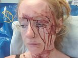 The bloodied face of school run mum severly injured in high speed smash with Rag n’ Bone Man’s wife – who’s NEVER said sorry or shown remorse, say family