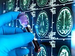 Alzheimer’s ‘wonder drug’ could delay disease for three years – 90% of brain damage vanished in new trial