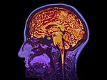 Common medication used to treat bipolar disorder and depression may help fight dementia